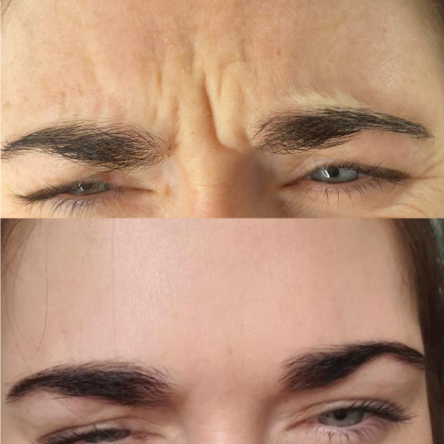 Anti-wrinkle injections before and after, softened frown lines