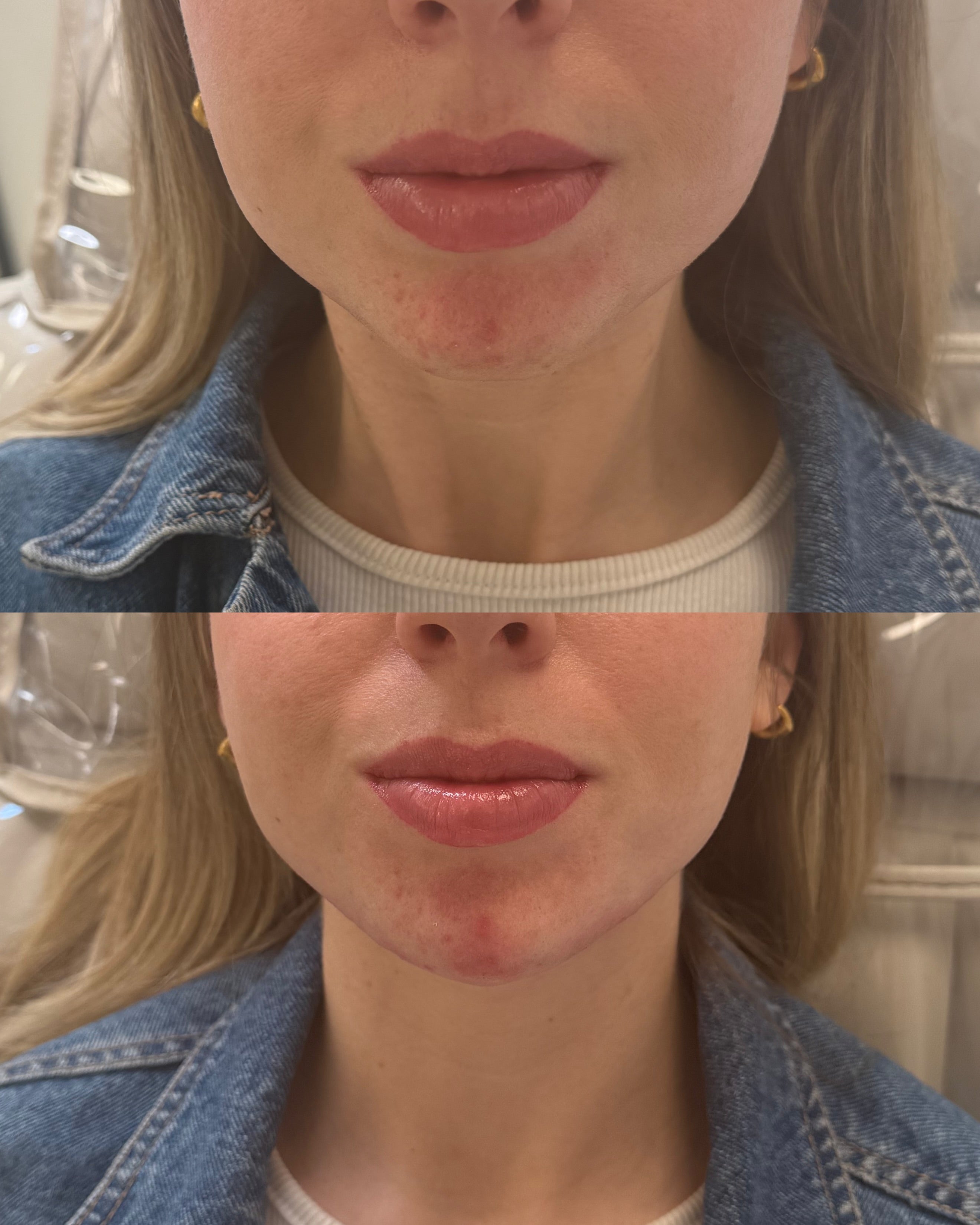 Prejowl filler before and after, contoured jawline