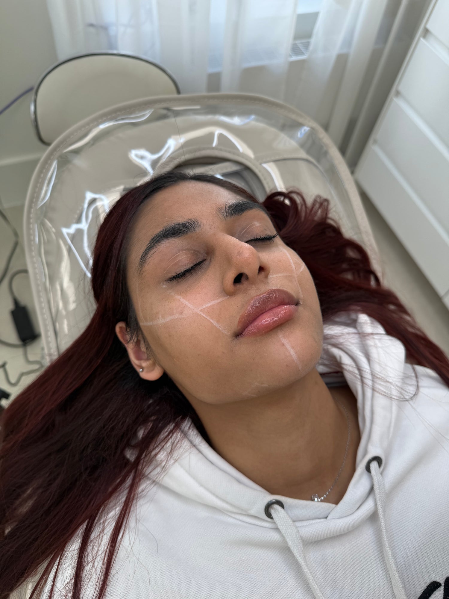 Chin and cheek filler for facial definition