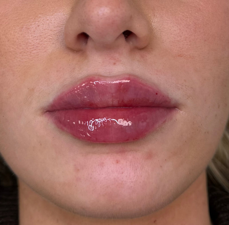 Natural lip filler results at Boss Babes Aesthetics Manchester