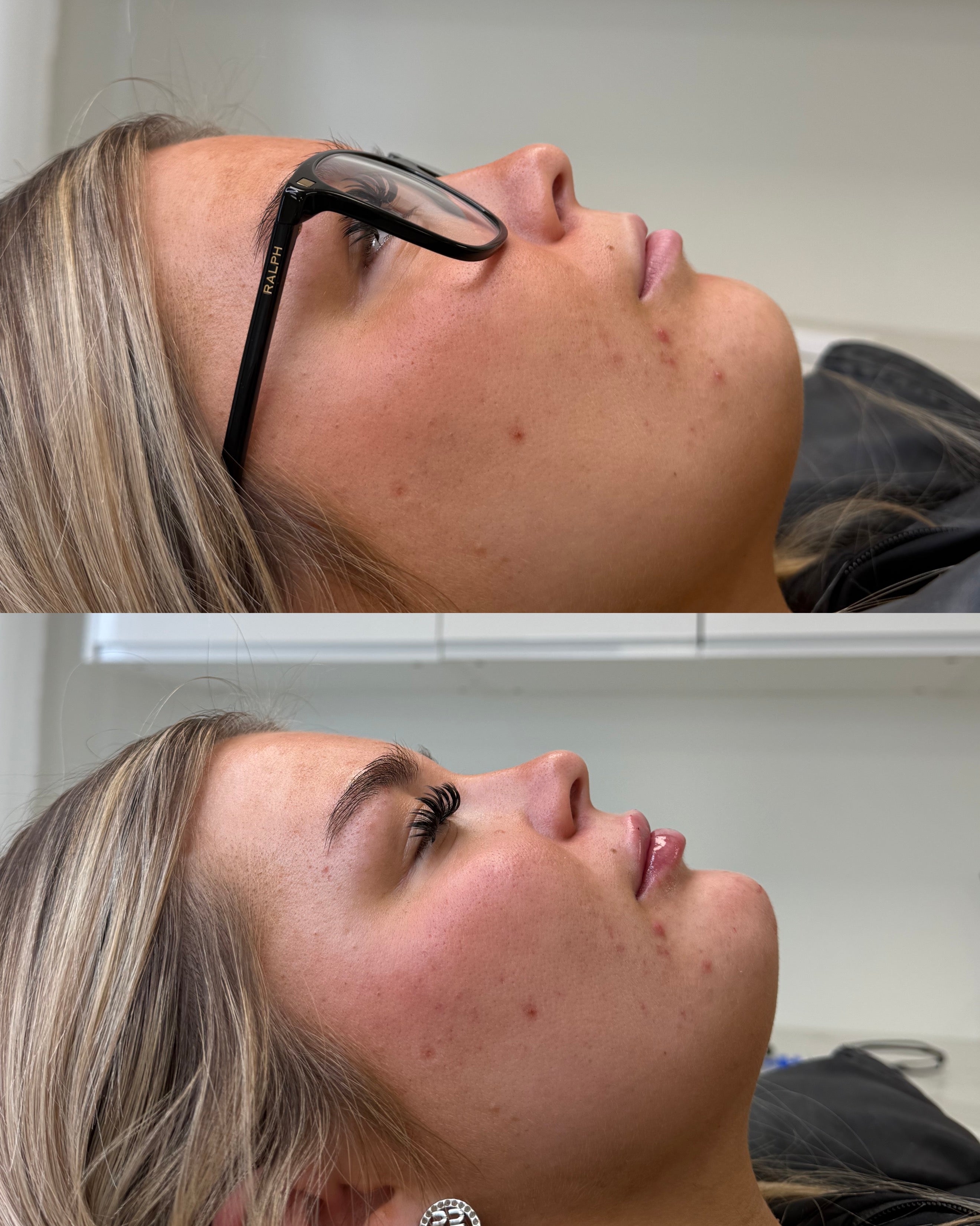 Chin filler before and after, improved side profile balance