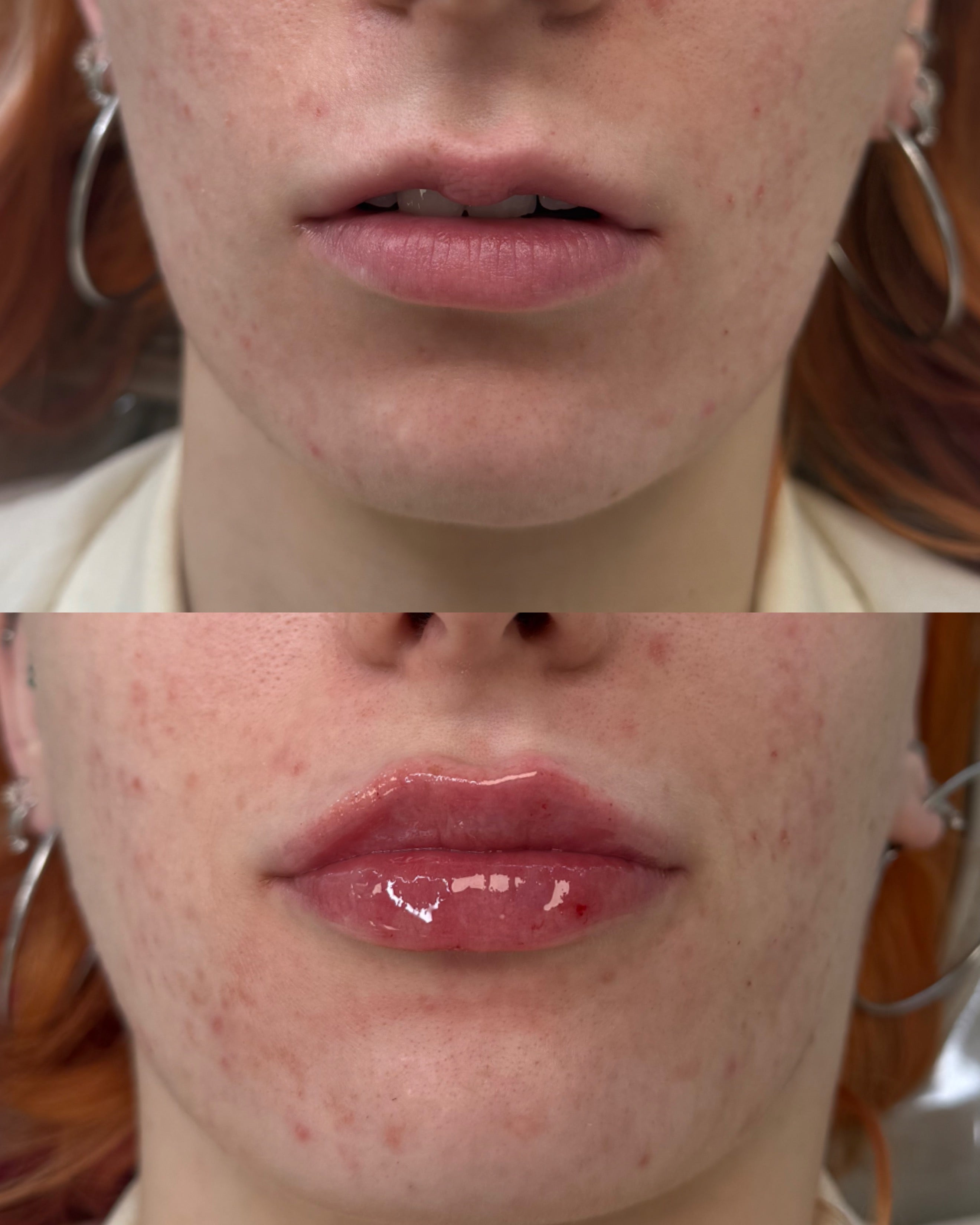 M shaped lips before and after lip filler correction