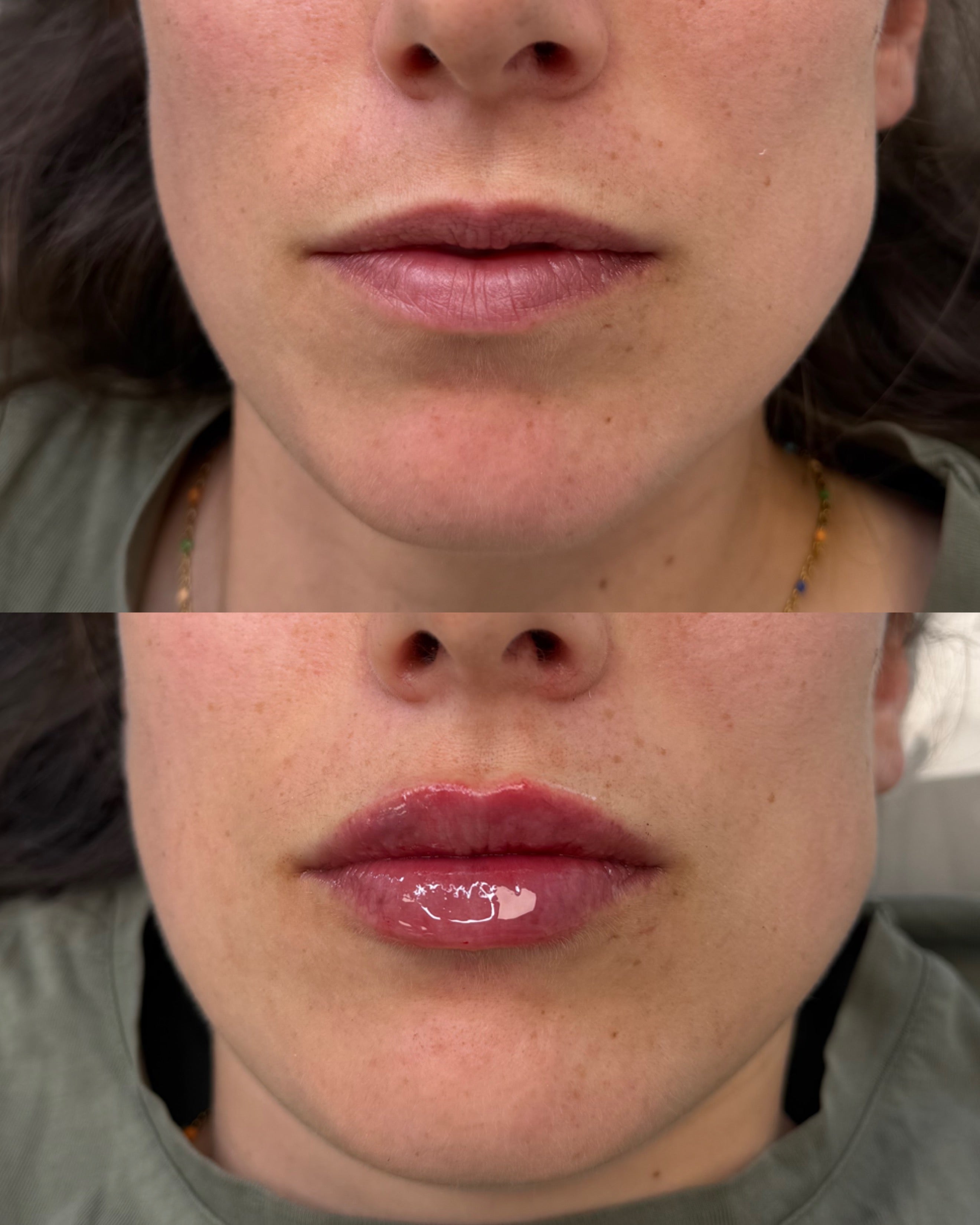 Natural lip filler before and after, subtle shape enhancement
