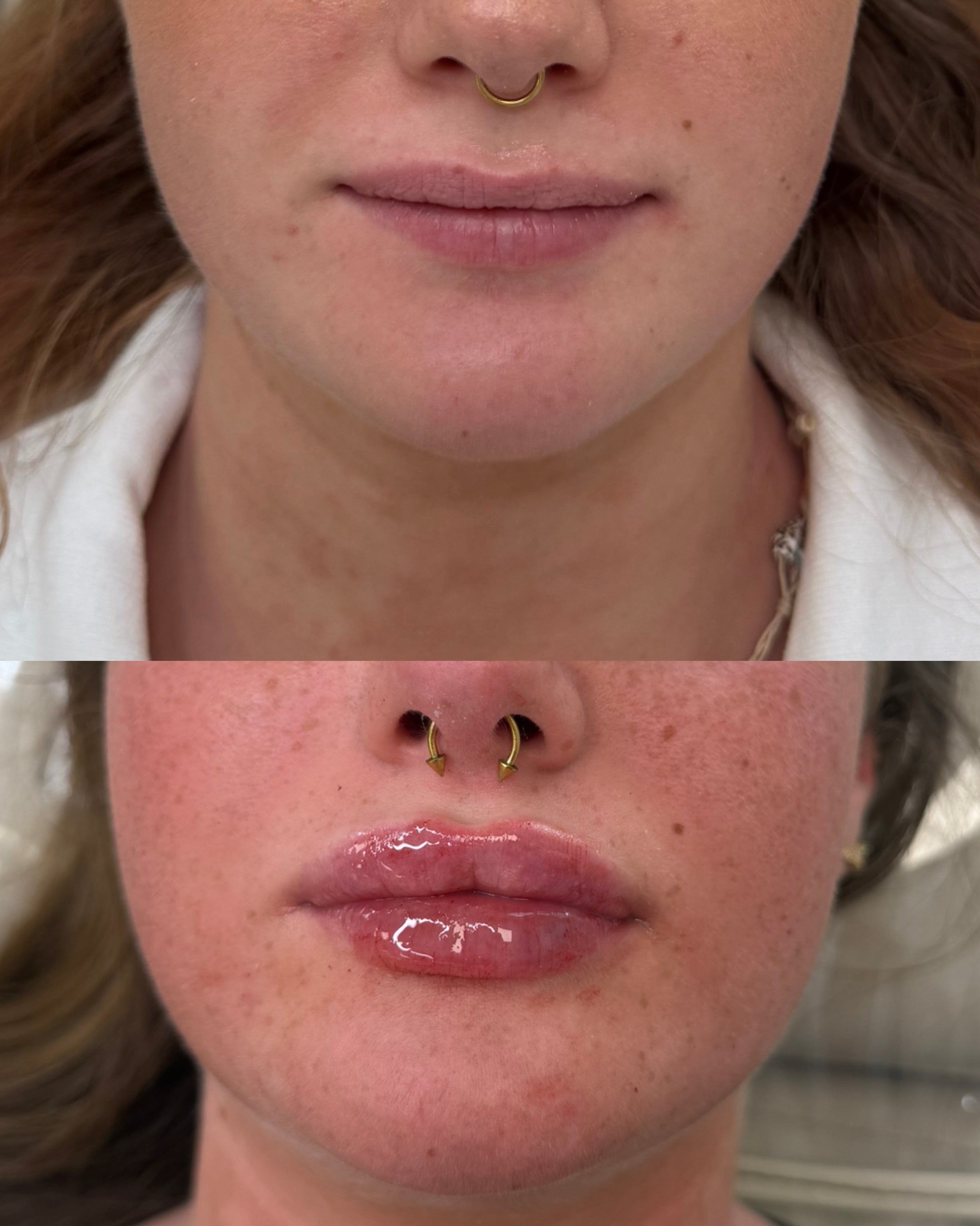 Lip filler volume enhancement before and after, front view