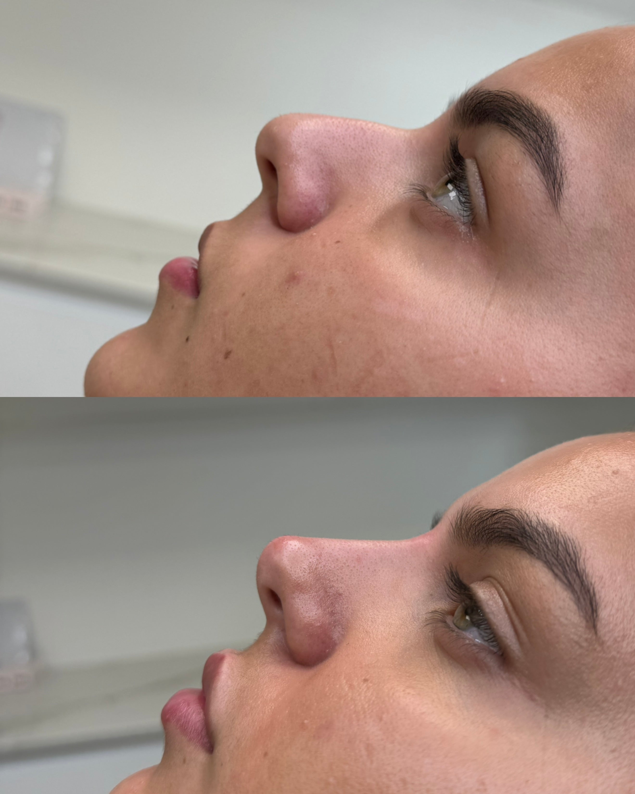 Natural non-surgical rhinoplasty before and after, side profile