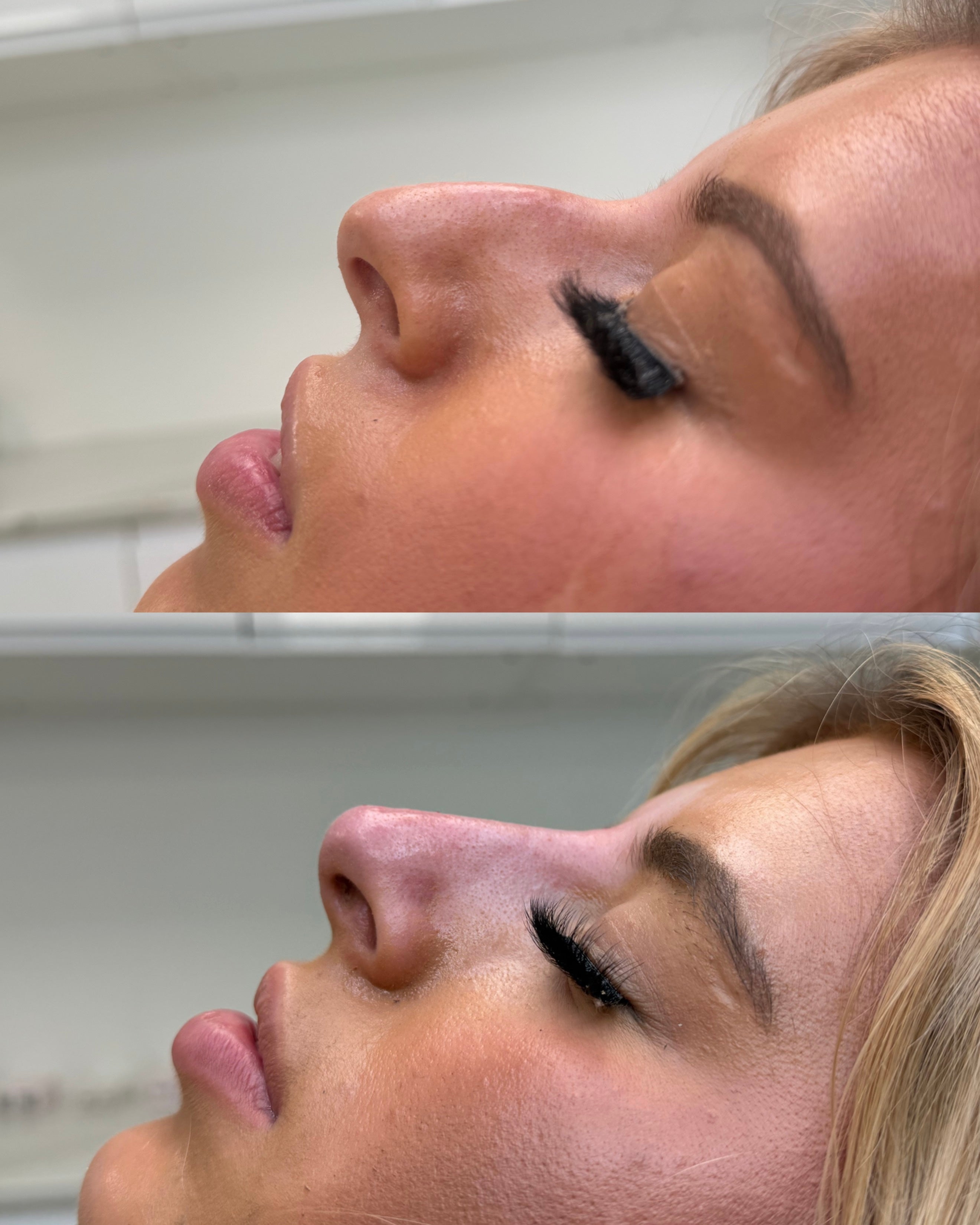Dorsal hump correction before and after, non-surgical rhinoplasty