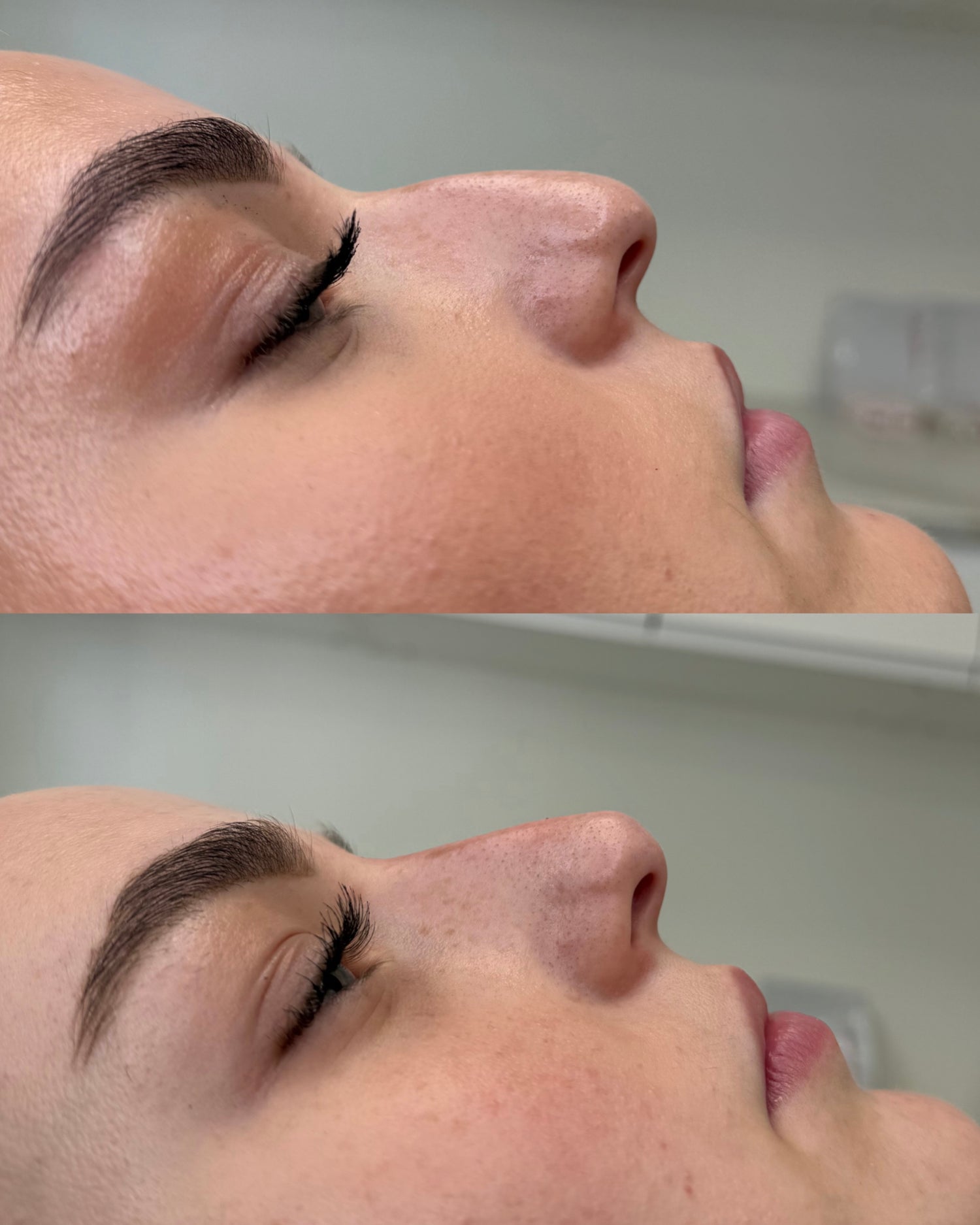 Before and after nose filler at Boss Babes Aesthetics Manchester