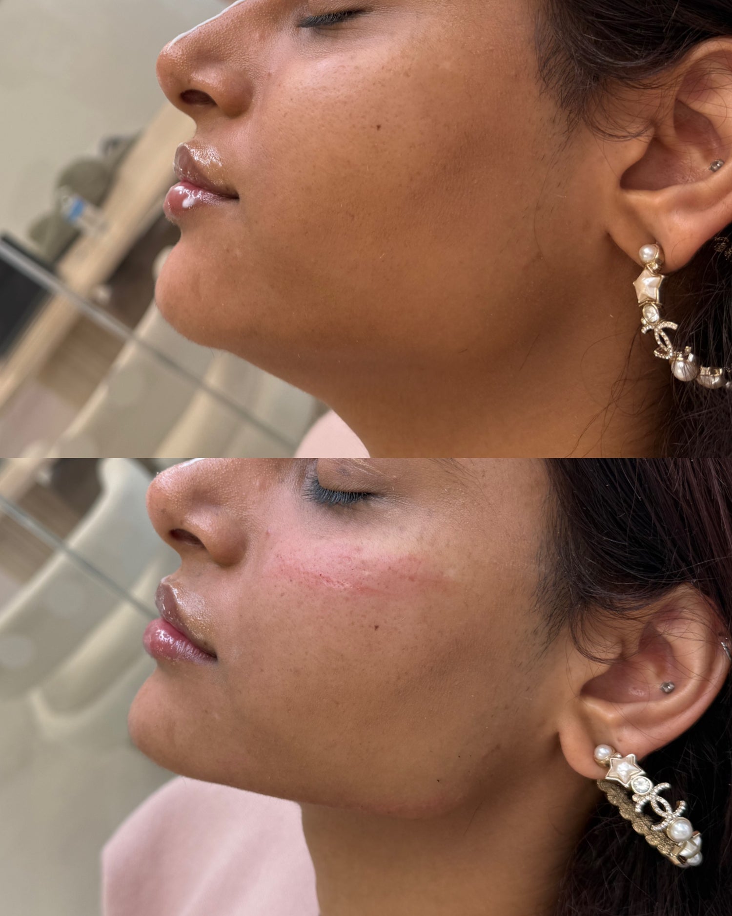 Jaw filler before and after at Boss Babes Aesthetics Manchester