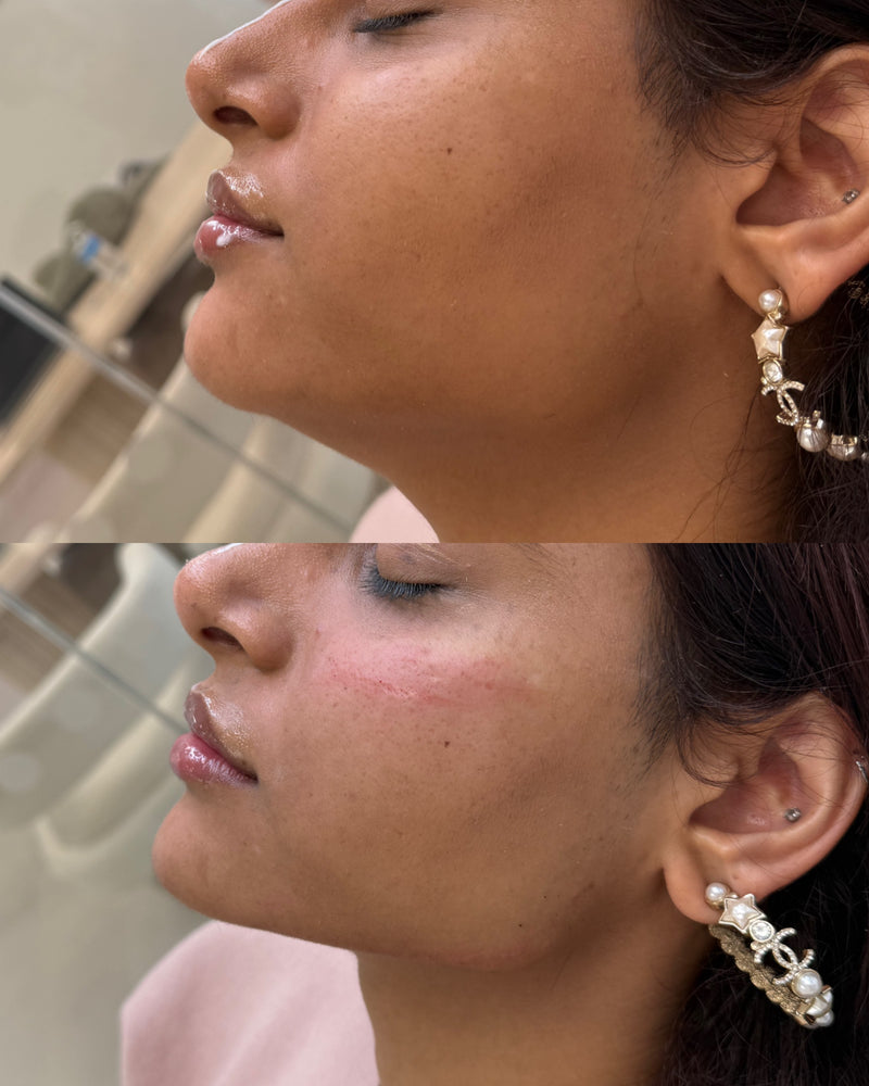 Jaw filler before and after at Boss Babes Aesthetics Manchester