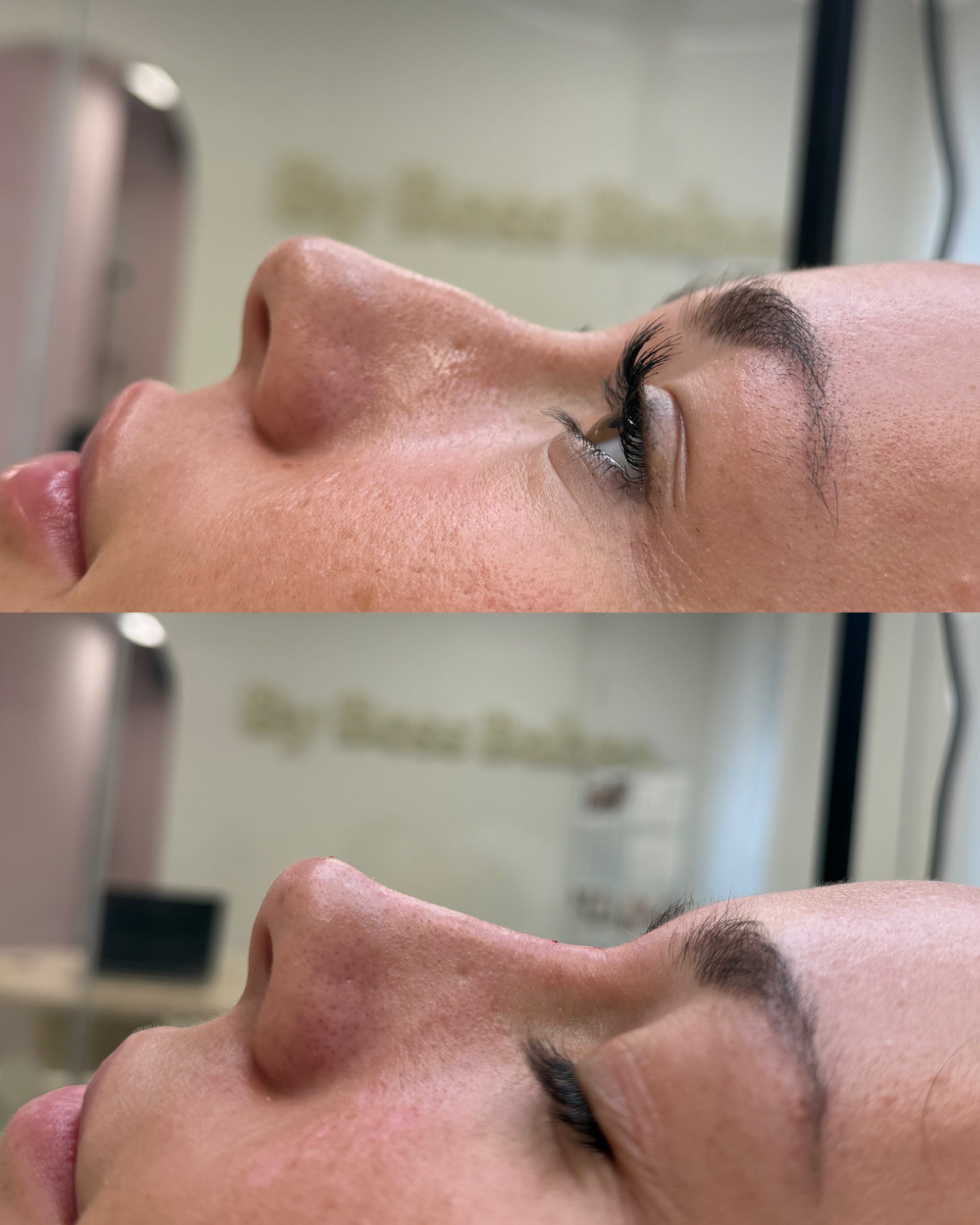 Pixie tip lift before and after with nose filler, side profile