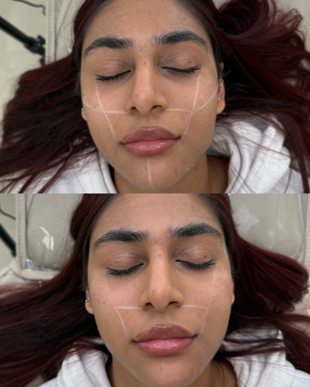 Cheek filler before and after showing defined cheekbones