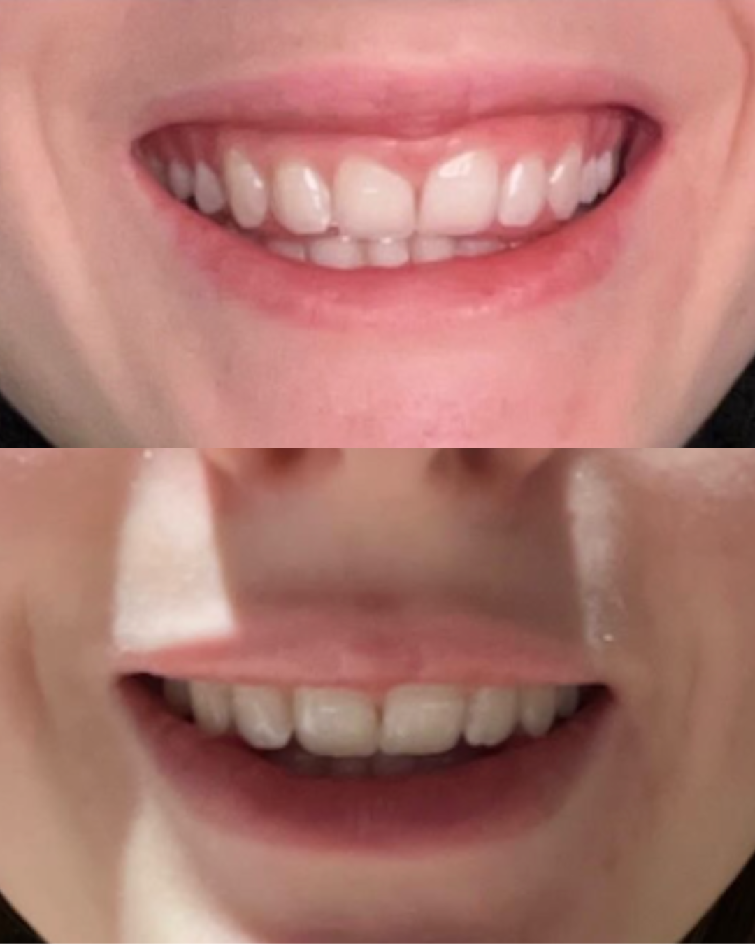 Lip flip before and after, fuller upper lip without filler