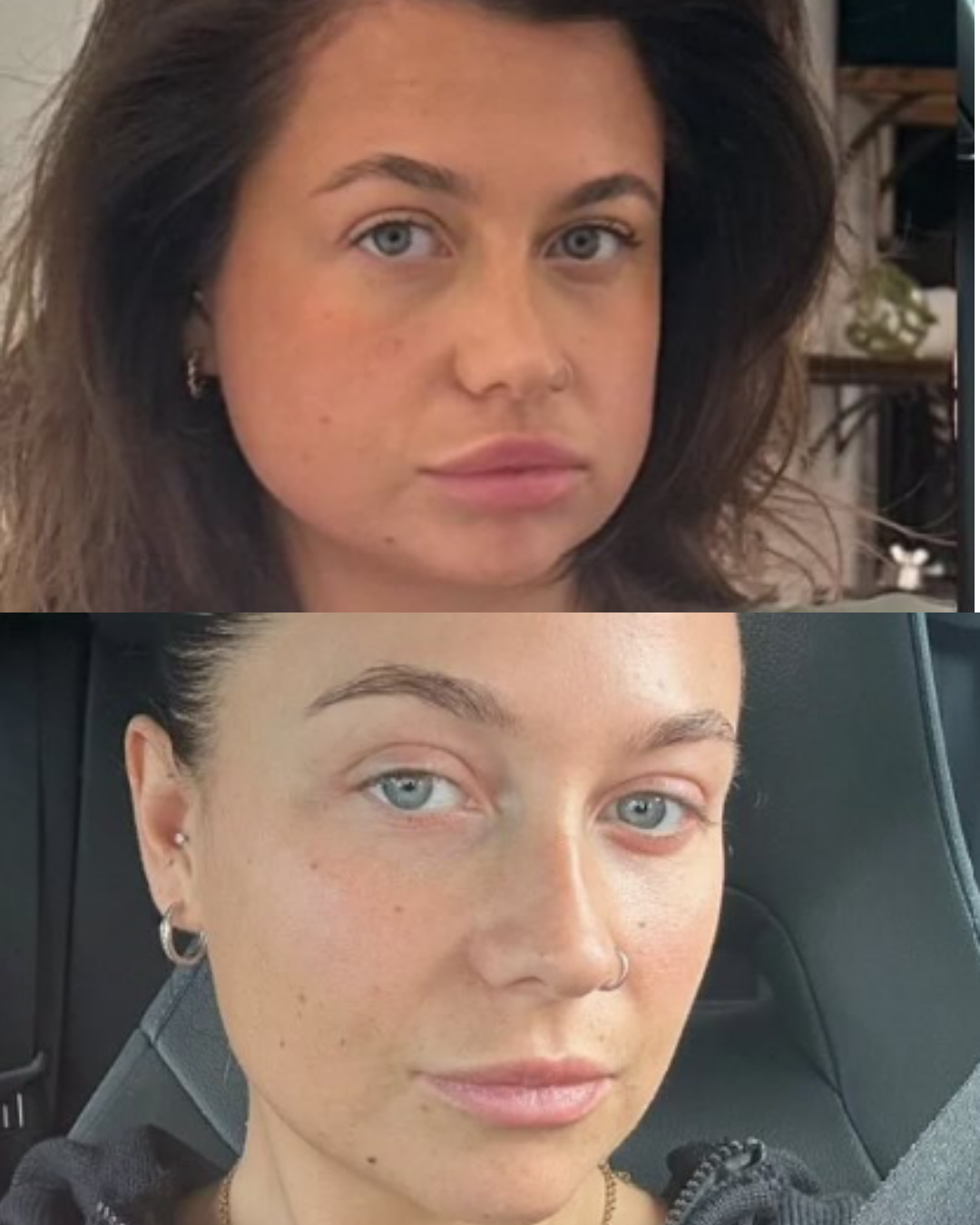 Masseter anti-wrinkle injections before and after, slimmed jaw