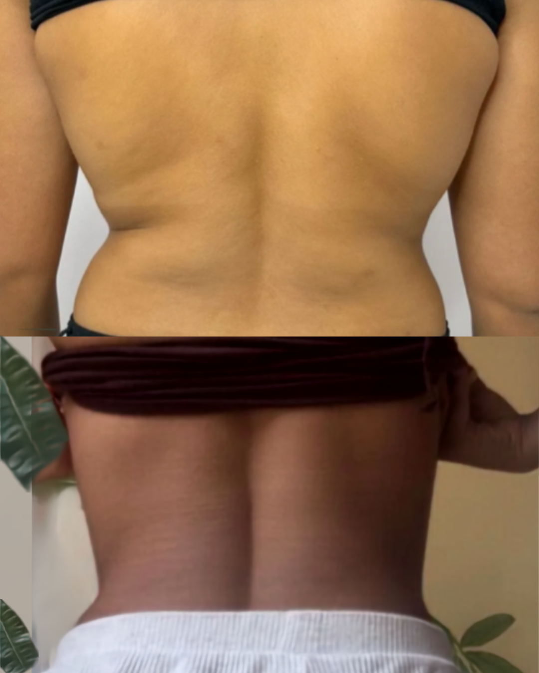 Lemon Bottle fat dissolving before and after, back and waist area